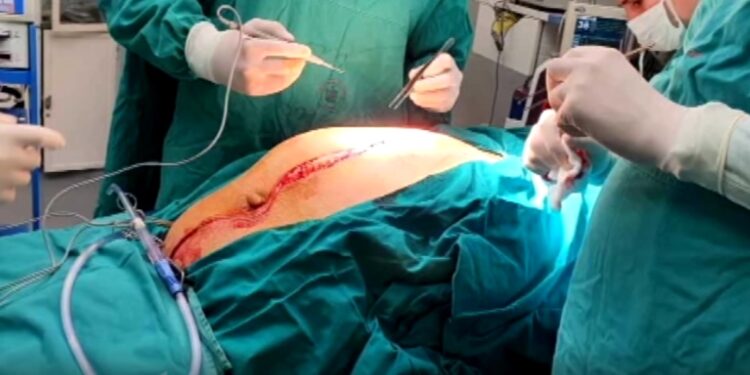 Veliki uspeh lekara Urgentnog centra: Odstranili tumor težak 50 kilograma