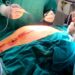 Veliki uspeh lekara Urgentnog centra: Odstranili tumor težak 50 kilograma