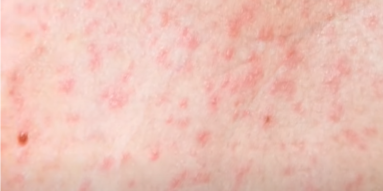 Preti epidemija malih boginja