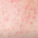 Preti epidemija malih boginja