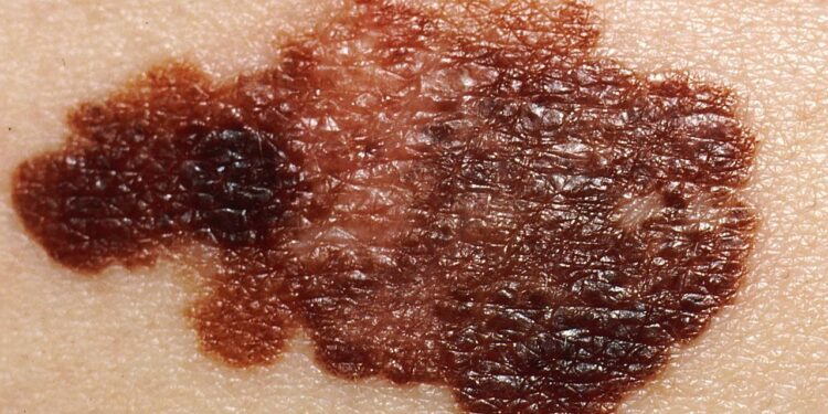 Sve više žrtava melanoma