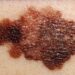 Sve više žrtava melanoma